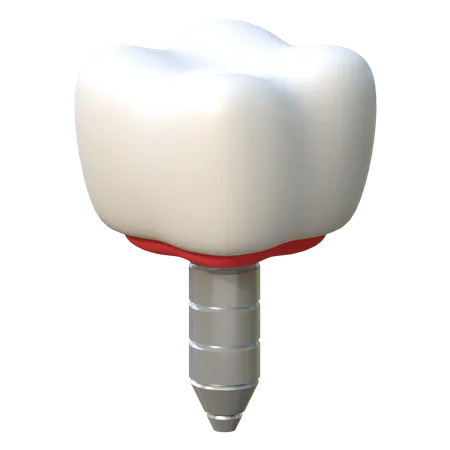 Implant dentaire  3D Icon