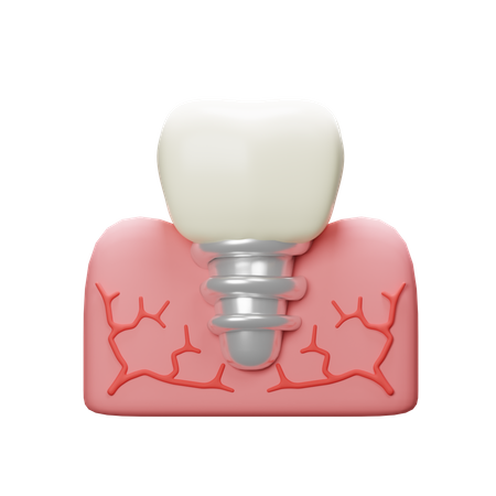 Implant Tooth  3D Icon