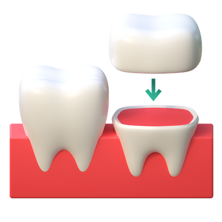 Implante de corona dental  3D Icon