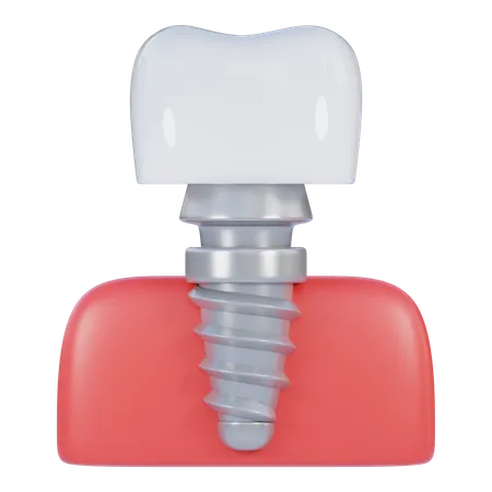 Implante dentário  3D Icon