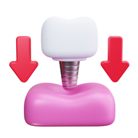 Implante dentário  3D Icon