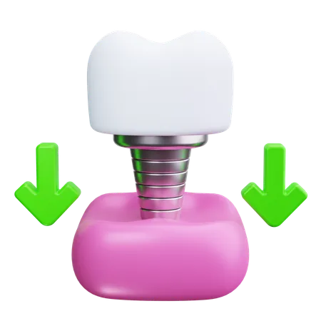 Implante dentário  3D Icon