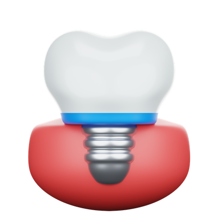 Implante dentário  3D Icon