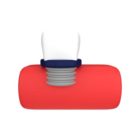 Implante dentário  3D Icon