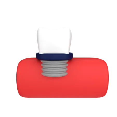 Implante dentário  3D Icon