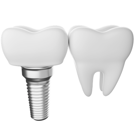 Implante dentário  3D Illustration