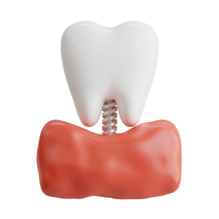 Implante dentário  3D Icon