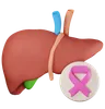 liver cancer