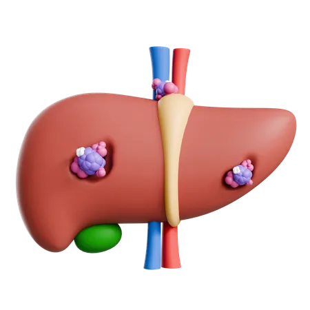 Liver Cancer  3D Icon