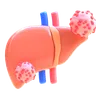 Liver Cancer