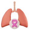 lung cancer