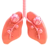 Lung Cancer