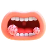 Mouth Cancer