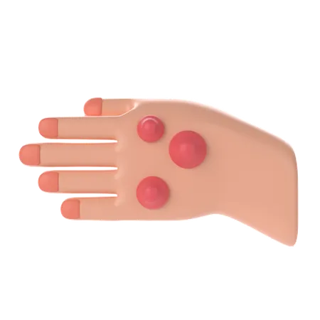 Nódulo reumatoide en la mano  3D Icon