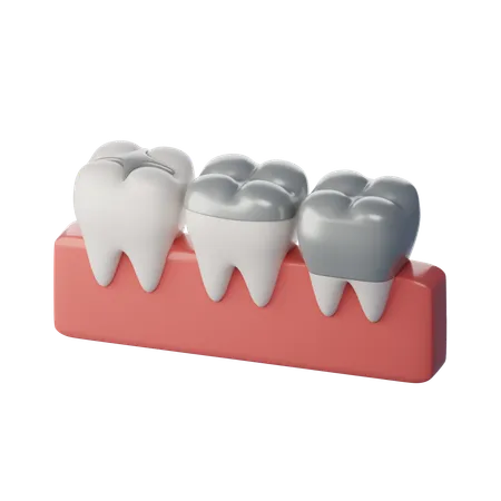 Obturação dentária  3D Icon