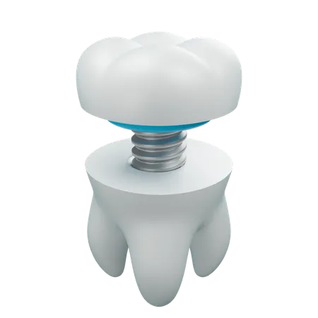 Obturação dentária 2  3D Icon
