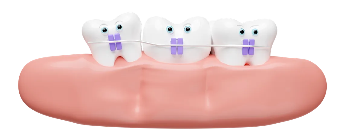 Desenhos Animados De Ortodontia 3 D Aparelho Dentario Com Gengiva Isolada 3D Illustration