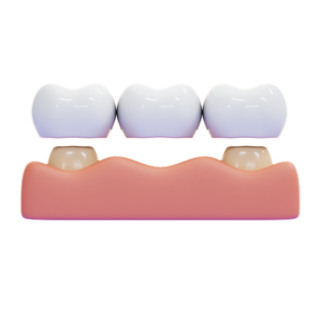 Puente dental  3D Icon