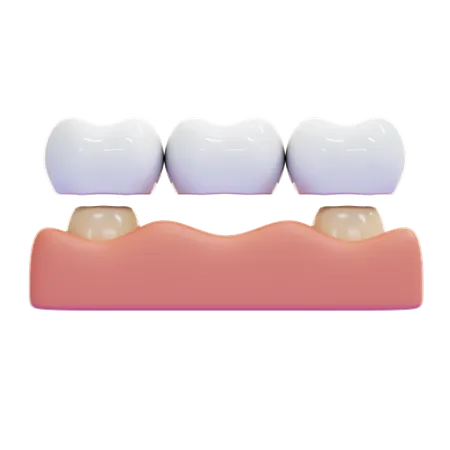 Puente dental  3D Icon