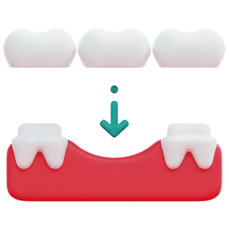 Puente de dientes  3D Icon