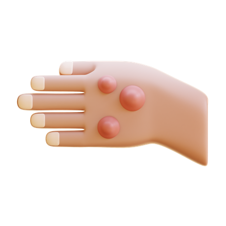 Rheumatoid Nodule  3D Icon