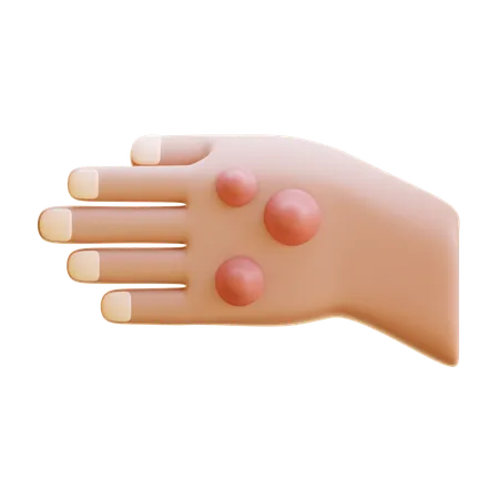 Rheumatoid Nodule  3D Icon