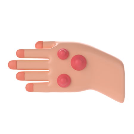 Rheumatoid Nodule Hand  3D Icon