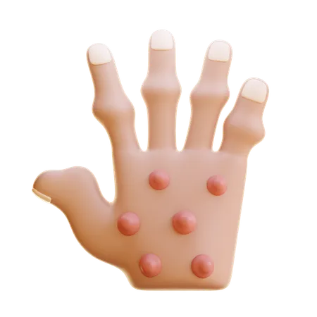 Rheumatoid Nodules  3D Icon