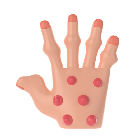 Rheumatoid nodules Palm  3D Icon