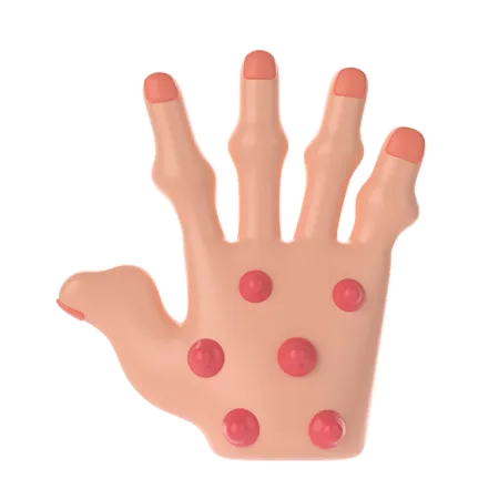 Rheumatoid nodules Palm  3D Icon