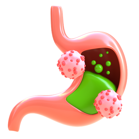 Stomach Cancer  3D Icon