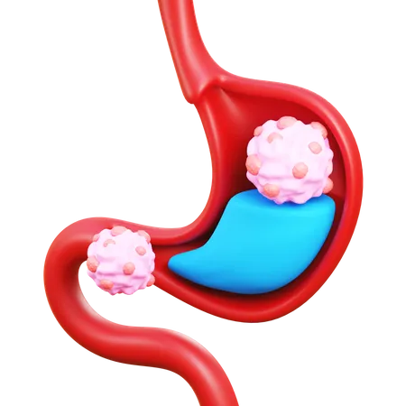 Stomach cancer  3D Icon