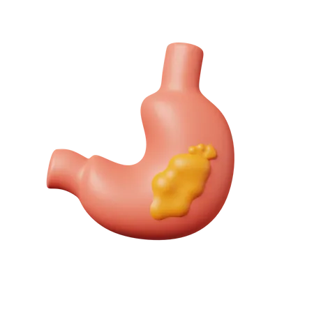 Stomach Cancer  3D Icon