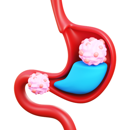 Stomach cancer  3D Icon