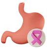 stomach cancer