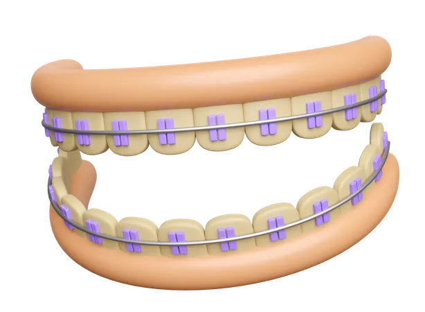 Teeth braces with gum  3D Illustration