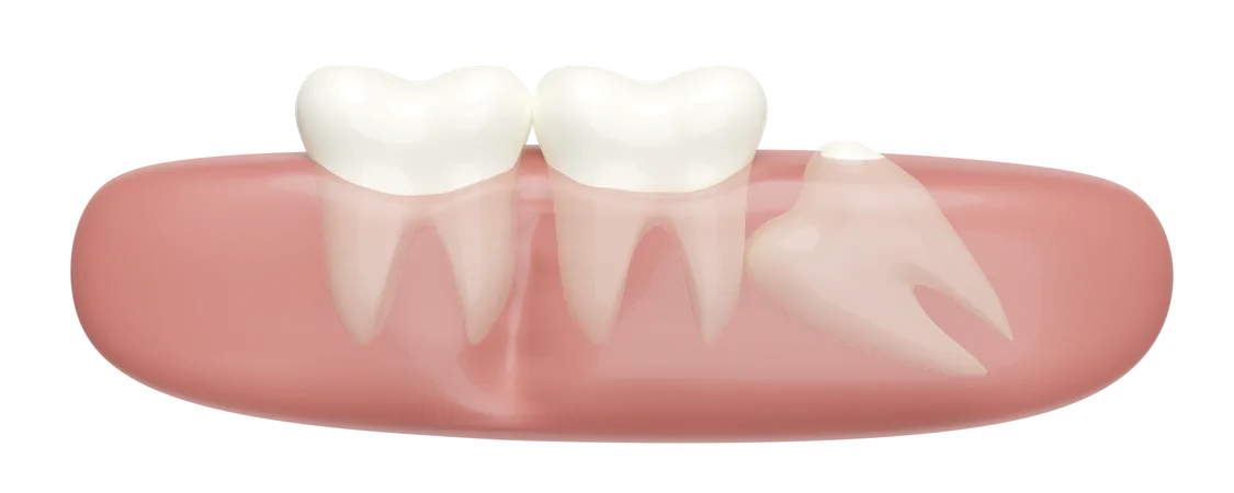 3 D Wisdom Teeth Model Problems Icon With Gums Isolated Dental Examination Of The Dentist Health Of White Teeth Oral Care 3D Illustration