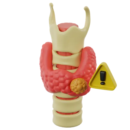 Thyroid Nodules And Cancer  3D Icon