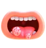 Tongue Cancer