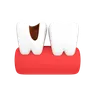 Tooth Cavity