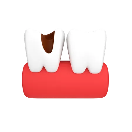 Tooth Cavity  3D Icon