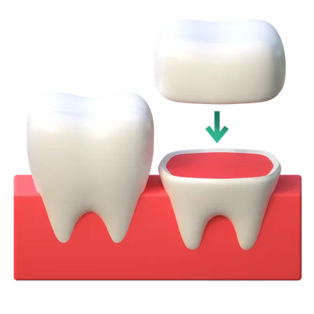 Tooth Crown Implant  3D Icon