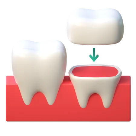 Tooth Crown Implant Procedure Icon Dental Care 3 D Illustration 3D Icon