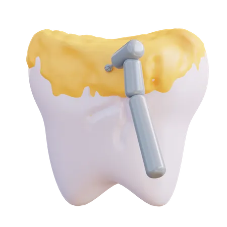 3 D Illustration Of Cleaning Tooth Decay With A Drill 3D Icon