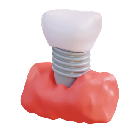 Tooth Implant  3D Icon