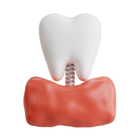 Tooth Implant  3D Icon