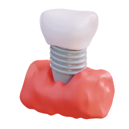 3 D Illustration Of Fitting Dentures 3D Icon