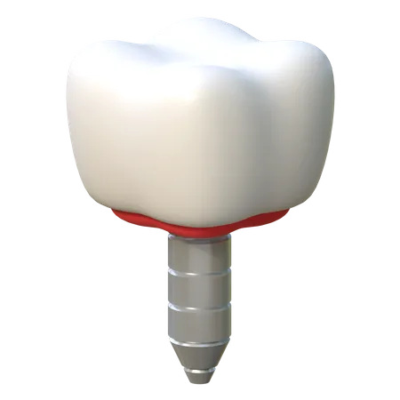 Tooth Implant Dental Care Icon 3 D Illustration 3D Icon