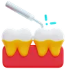 Tooth Scaling Treatment