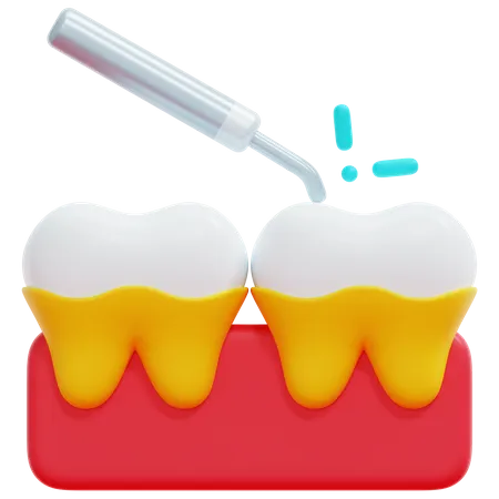 Tratamento de raspagem dentária  3D Icon